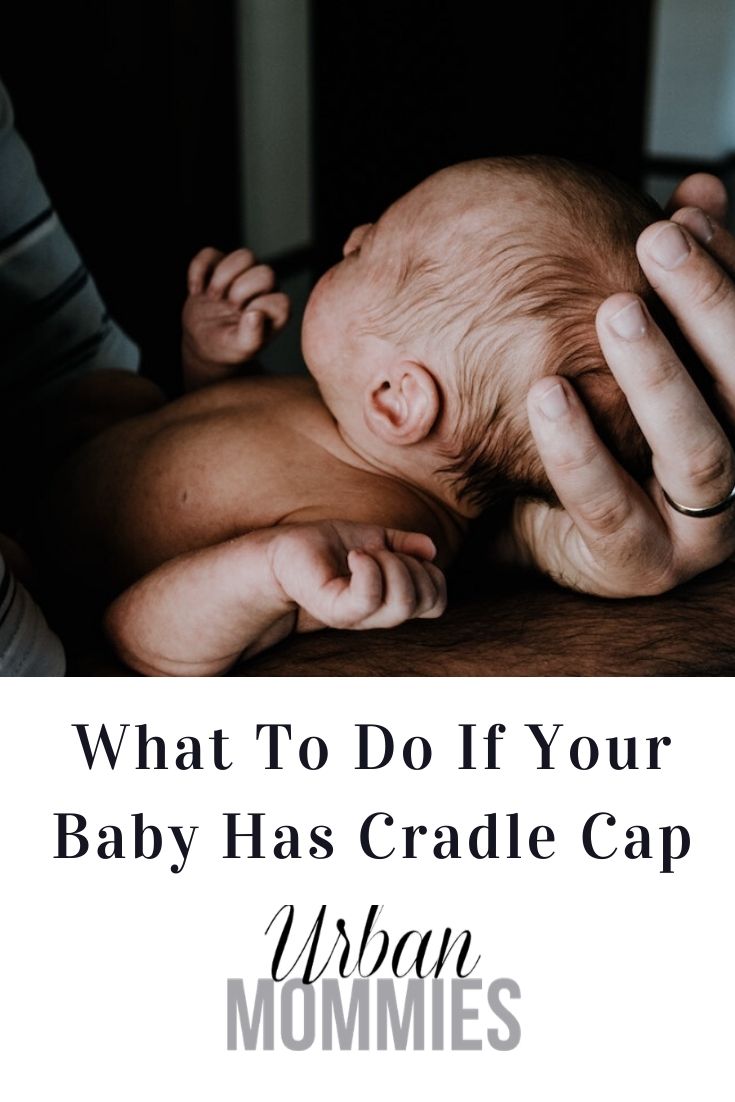 What To Do If Your Baby Has Cradle Cap Urban Mommies